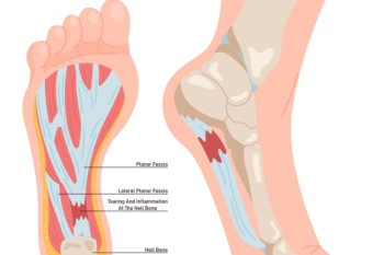 When You Might Need Surgery for Plantar Fasciitis