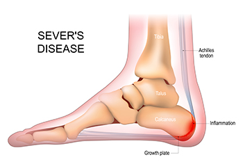 Understanding Sever’s Disease