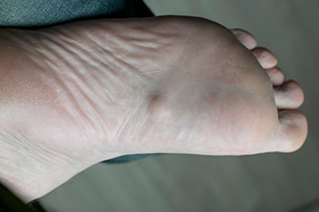 What Is Plantar Fibromatosis?