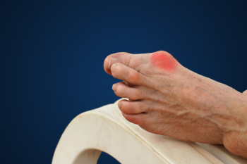 Why Bunions Develop