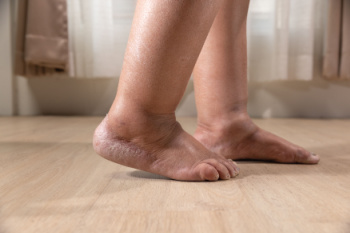 Common Causes of Swollen Feet and Ankles