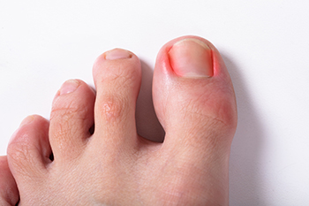 What Causes an Ingrown Toenail?