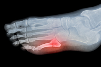 Broken Toe Causes and Risk Factors