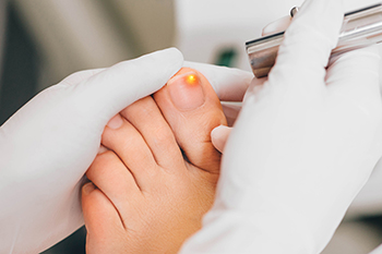What Causes Toenail Fungus and How It Is Treated