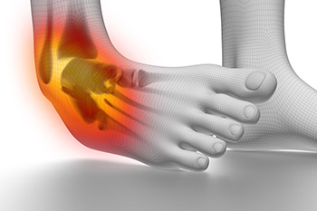 What Causes Ankle Instability?